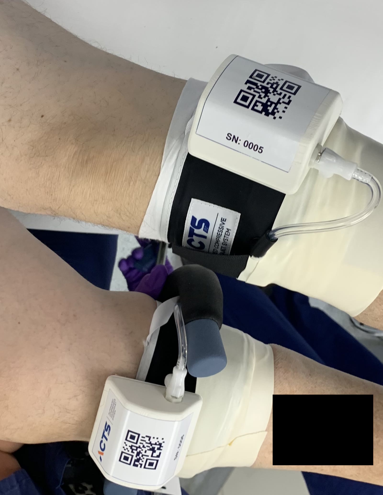 The ACTS wireless surgical tourniquet system applied to a patient
